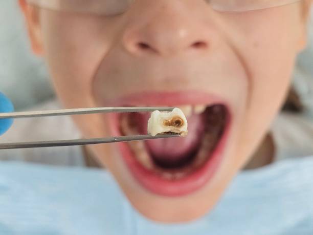 Best Cracked Tooth Emergency Dentist  in Cresson, TX